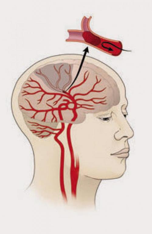 20160217-ischemic-stroke_1_0.jpg