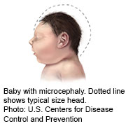 microcephaly_sm.jpg